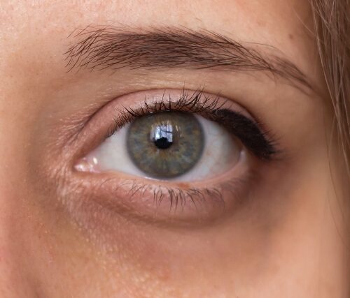 ¿Qué tipo de ojeras tengo?